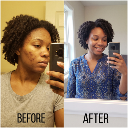 Pear™ - Acne Cream
